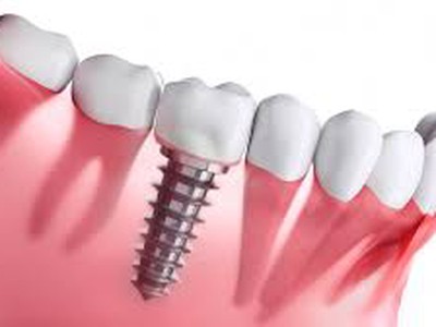 Warning Signs and Risk Mitigation for a Dental Implant in Vietnam 0