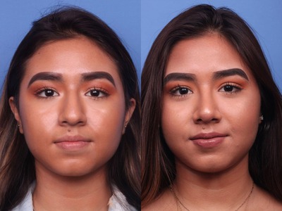 Rhinoplasty in Vietnam: World-Class Results at Affordable Prices 0