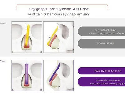 Nâng mũi 3d fitme có đặc điểm gì nổi bật 0