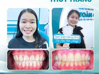 Niềng răng có giúp mặt hết lệch không 0