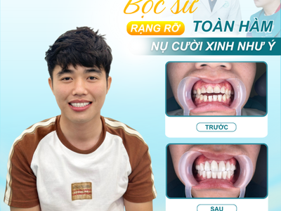 Bọc răng sứ có làm yếu răng không Hiểu đúng để tránh lo lắng 0
