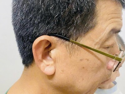 Lắp đặt máy trong tai thẩm mỹ cho bác khách ở Văn Giang   Hưng yên 2